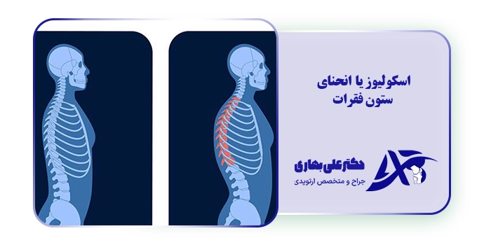 اسکولیوز یا انحنای
ستون فقرات