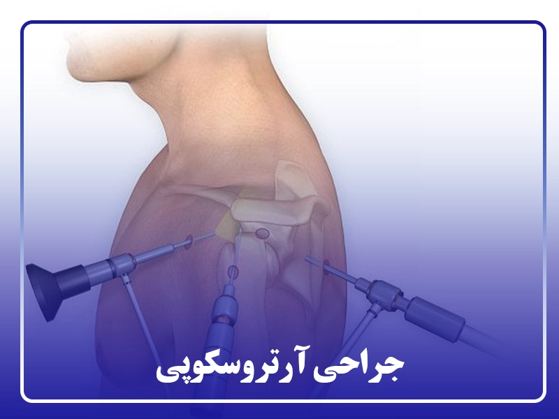 جراحی آرتروسکوپی
