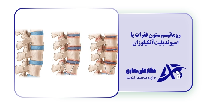 روماتیسم ستون فقرات یا اسپوندیلیت آنکیلوزان