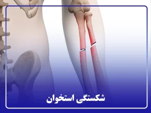 شکستگی استخوان