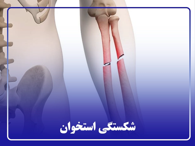 شکستگی استخوان