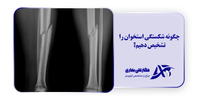 چگونه شکستگی استخوان را تشخیص دهیم؟