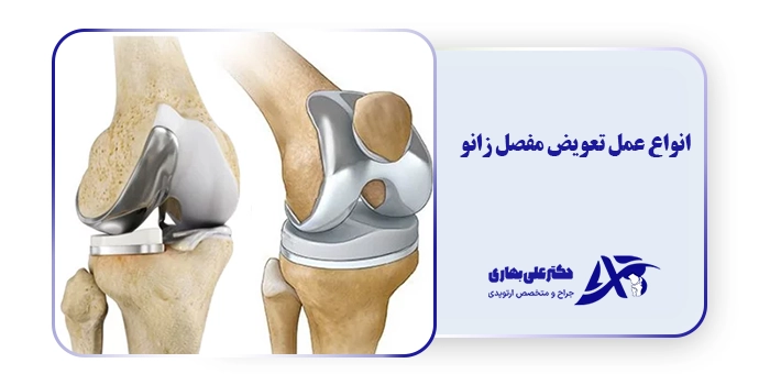 انواع عمل تعویض مفصل زانو