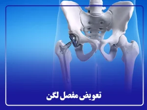 تعویض مفصل لگن
