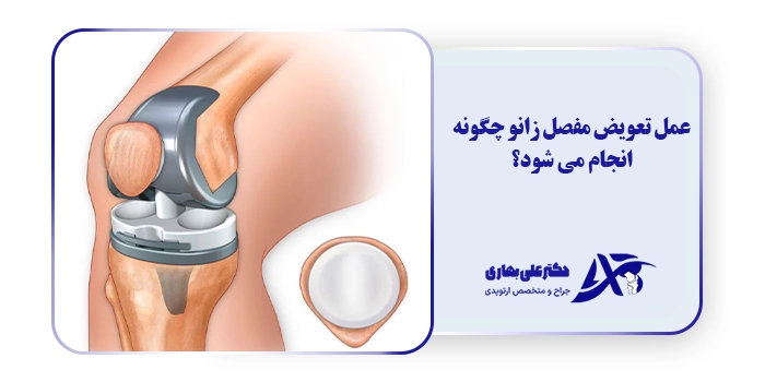 عمل تعویض مفصل زانو چگونه انجام می شود؟