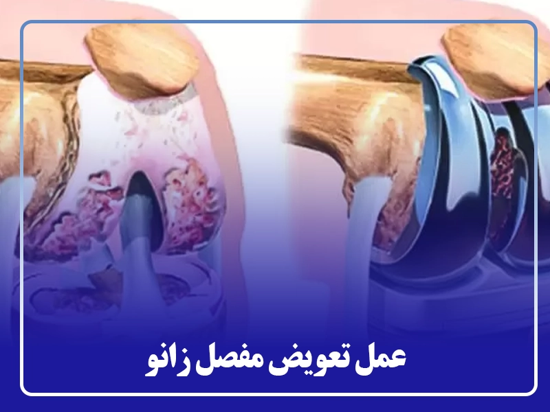 عمل تعویض مفصل زانو