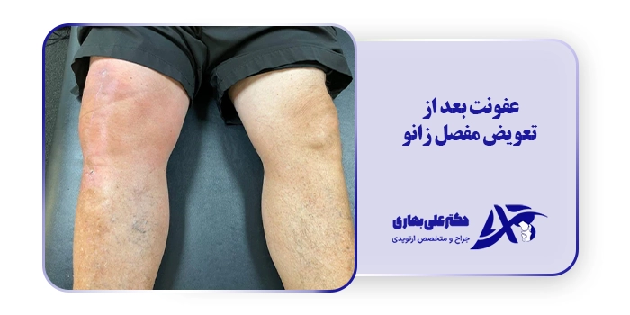 عفونت بعد از تعویض مفصل زانو