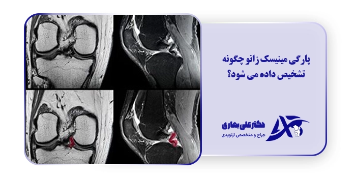 پارگی مینیسک زانو چگونه تشخیص داده می شود؟