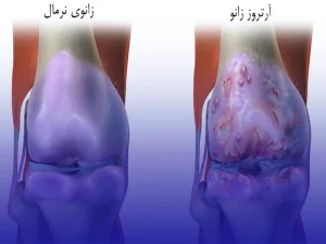 آرتروز زانو