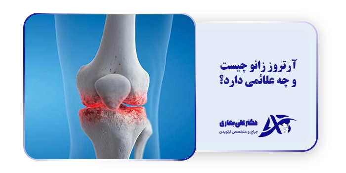 آرتروز زانو چیست و چه علائمی دارد؟