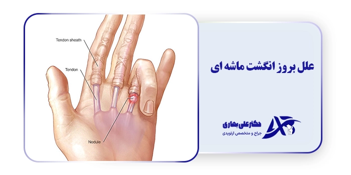 علل بروز انگشت ماشه ای
