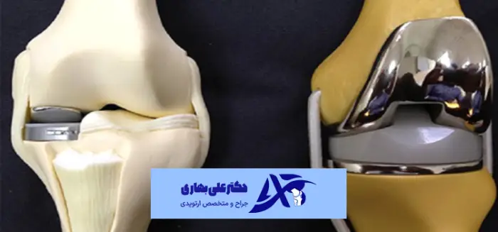 هزینه تعویض مفصل زانو در بیمارستان دولتی و خصوصی