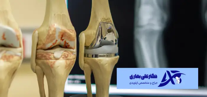 هزینه تعویض مفصل زانو در سال 1404 چقدر است؟