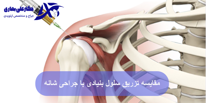 مقایسه تزریق سلول بنیادی با جراحی شانه