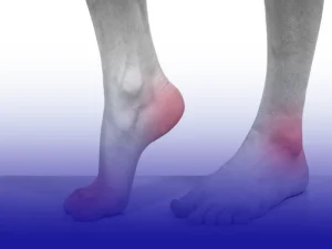 علائم شایع دیسک کمر در پاها