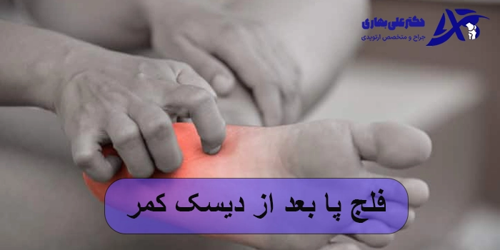 فلج پا بعد از دیسک کمر