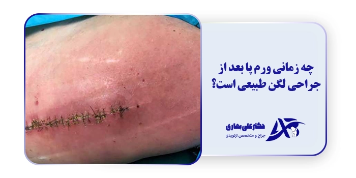 چه زمانی ورم پا بعد از جراحی لگن طبیعی است؟