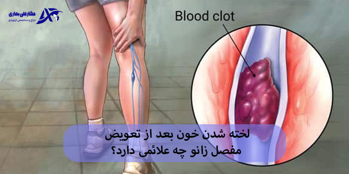 لخته شدن خون بعد از تعویض مفصل زانو چه علائمی دارد؟